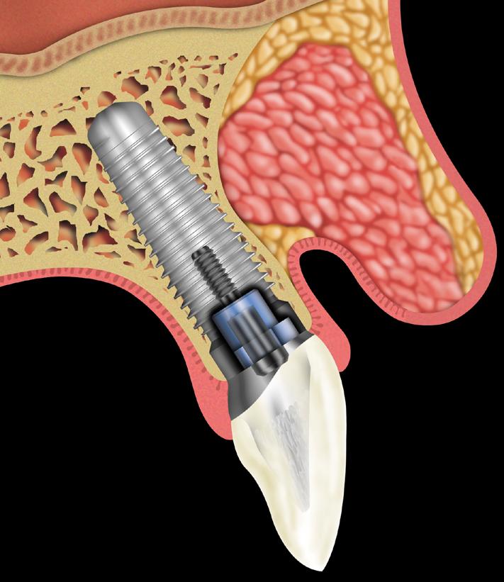 implant